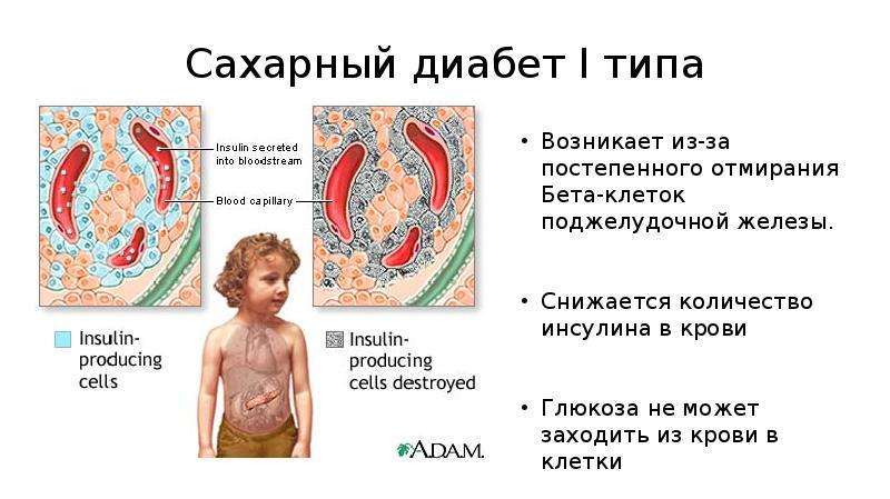 Диабетики 1 типа. Клиника сахарного диабета 1 типа. Сахарный диабет первого типа клиника. Бета клетки при сахарном диабете 1 типа. Клиника СД 1 типа у детей.