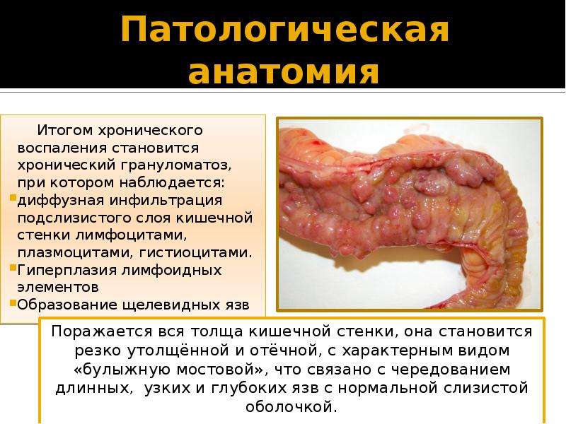   Патологическая анатомия
 Итогом хронического воспаления становится хронический грануломатоз, при котором наблюдается: 
диффузная инфильтрация подслизистого слоя кишечной стенки лимфоцитами, плазмоцитами, гистиоцитами.
Гиперплазия лимфоидных элементов
Образование щелевидных язв
