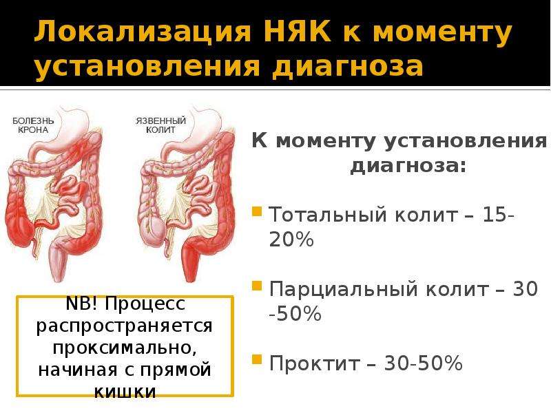   Локализация НЯК к моменту установления диагноза 
К моменту установления диагноза:
Тотальный колит – 15-20%
Парциальный колит – 30 -50%
Проктит – 30-50%
