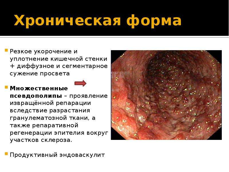   Хроническая форма 
Резкое укорочение и уплотнение кишечной стенки + диффузное и сегментарное сужение просвета
Множественные псевдополипы – проявление извращённой репарации вследствие разрастания гранулематозной ткани, а также репаративной регенерации эпителия вокруг участков склероза.
Продуктивный эндоваскулит 
