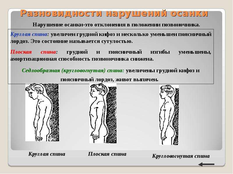 Рассмотрите рисунки 1 3 с изображением изменений осанки человека как называется нарушение осанки 3