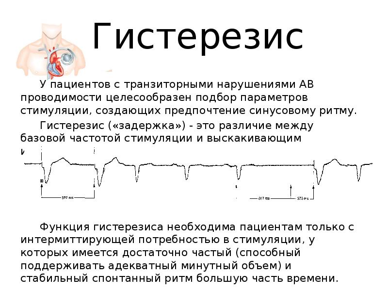 Экг с кардиостимулятором картинки