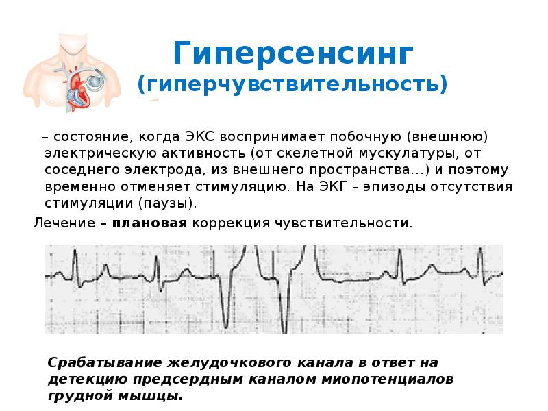 Экс это. Гиперсенсинг на ЭКГ. Гиперсенсинг экс на ЭКГ. Гиперсенсинг по желудочковому электроду. Предсердный Гиперсенсинг при экс.