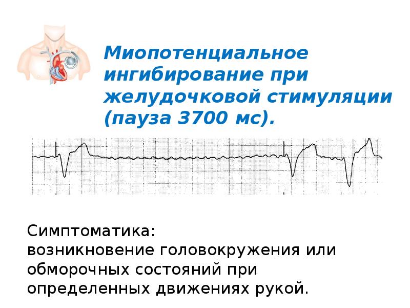 Экстрасистолия лечение