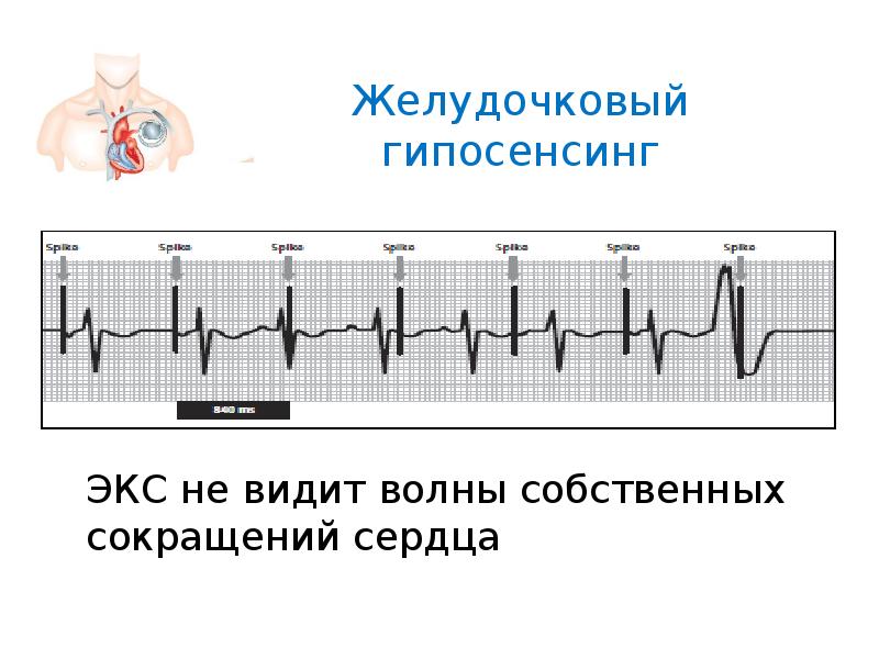 Экс контакты. Гипосенсинг экс. ЭКГ Валента. Желудочковый гипосенсинг. Экс на ЭКГ.