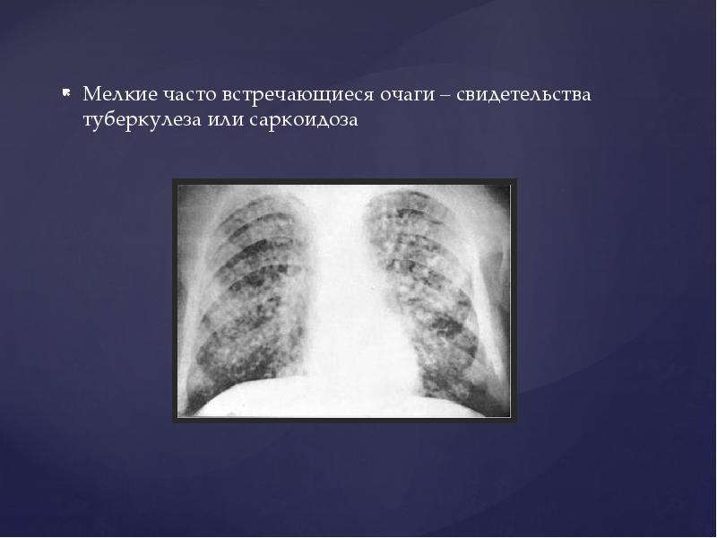 Мелко часто. Саркоидоз лёгких на рентгене. Саркоидоз легких очаги.