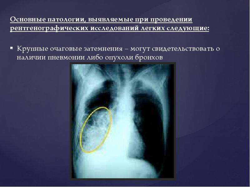 Презентация рентген легких