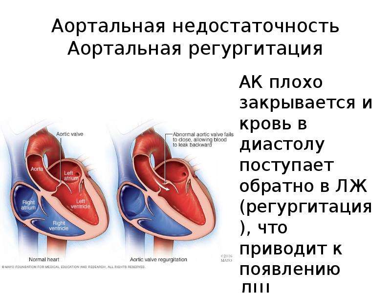 Аортальный градиент. Регургитация аортального клапана степени. Регургитация 2-3 степени аортального клапана. Регургитация аортального клапана 1 степени. Аортального клапана с регургитацией 1-2 степени.