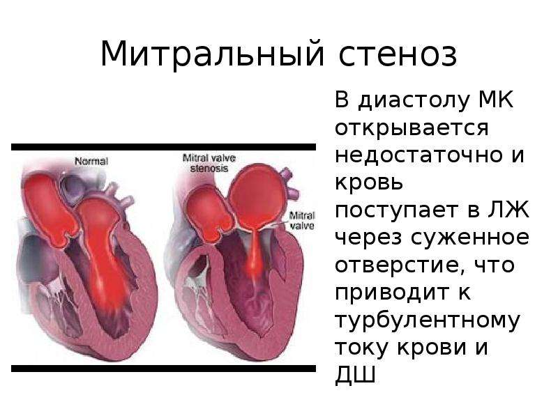 Сердечный стеноз. Сужение митрального клапана. Ток крови при митральном стенозе. Сердце при митральном стенозе схема. Сердце при митральном стенозе.