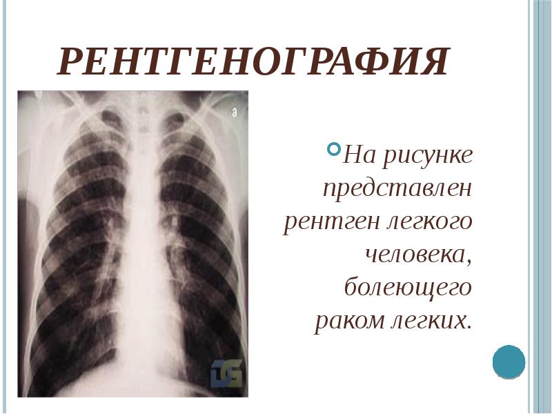 Рентгенография На рисунке представлен рентген легкого человека, болеющего раком легких.