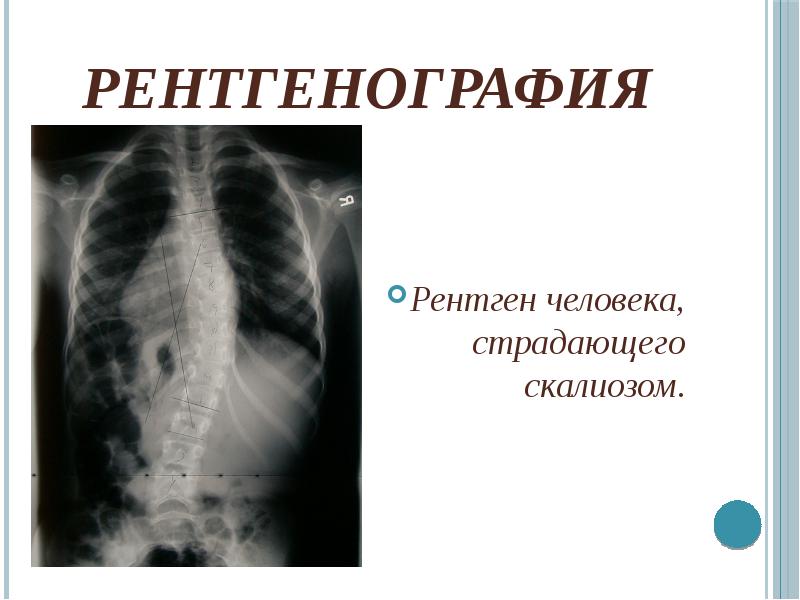 Рентгенография Рентген человека, страдающего скалиозом.
