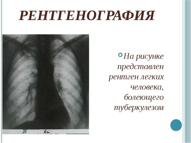 Рентгенография На рисунке представлен рентген легких человека, болеющего туберкулезом