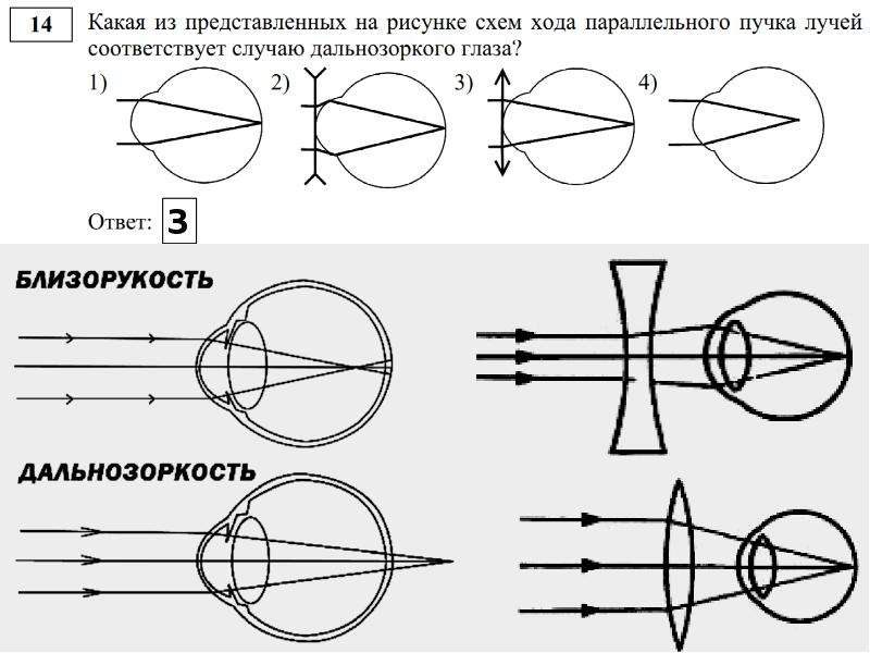 Какая из схем хода лучей в глазу человека соответствует случаю дальнозоркости глаза с очками