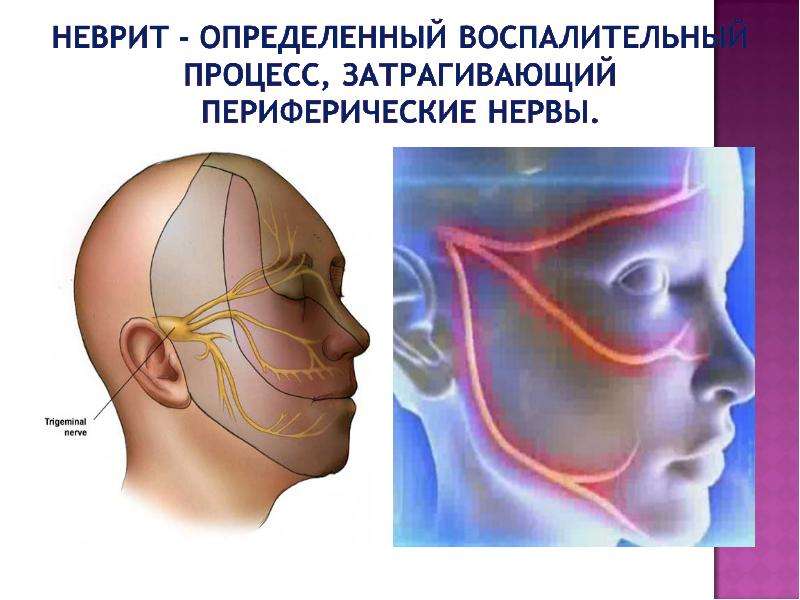 Воспаление тройничного нерва на лице симптомы фото