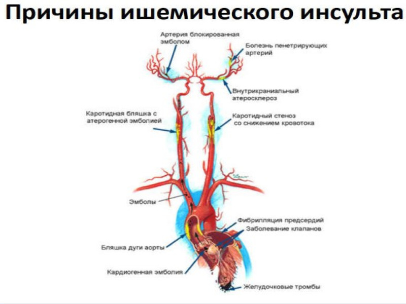 Повторный инсульт. Повторный инсульт причины. Вторичный инсульт и его последствия. Отчего бывает повторный инсульт.