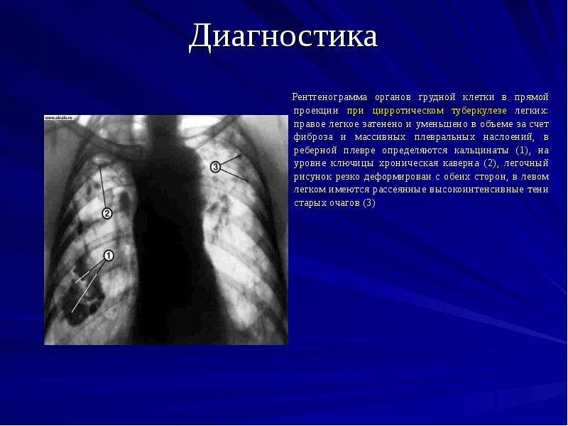 Последствия фиброза. Фиброз плевральные наслоения. Цирротический туберкулез рентген. Плевральные наслоения рентген.