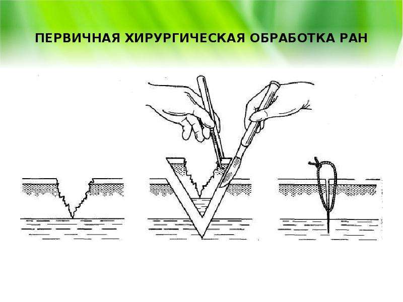 Первичная хирургическая обработка. Первичная хирургическая обработка РАН лица. Первичная хирургическая обработка раны задачи. Эволюция первичной хирургической обработки.