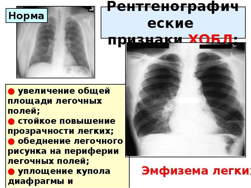 Легочное поле повышенной прозрачности. Обеднение легочного рисунка. Повышение прозрачности легочного рисунка. Обеднение рисунка легких. Распространенное обеднение легочного рисунка.