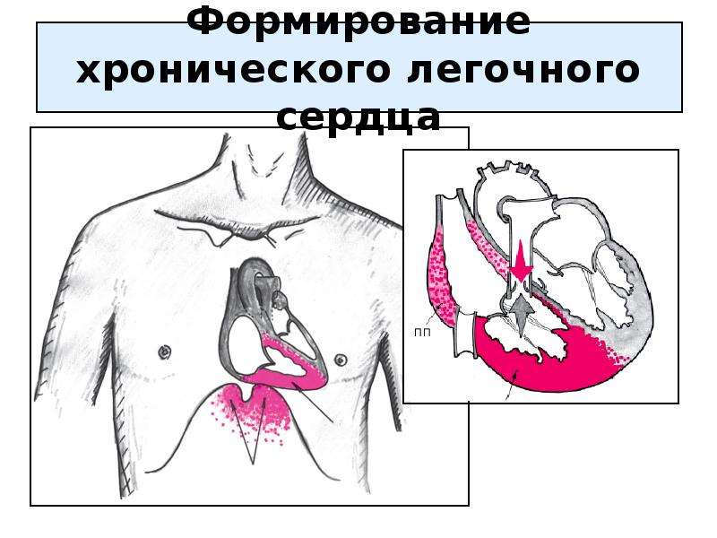 Легочное сердце картинки