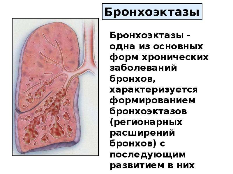 Бронхит презентация по биологии