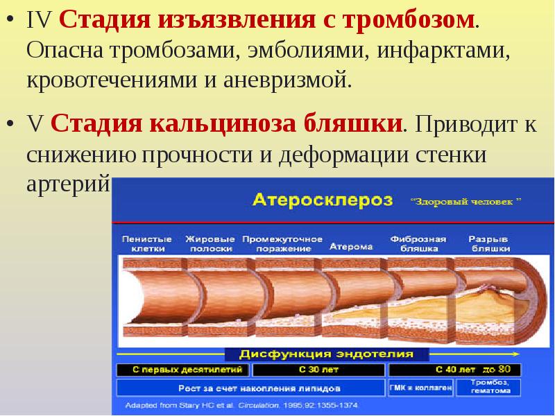 Стадии тромбоза. Этапы образования тромбоза. Стадии тромбообразования. Стадии образования тромба. Стадия изъязвления бляшки.