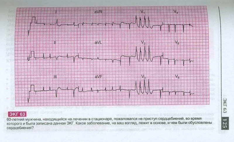 Патологии на экг фото с расшифровкой примеры