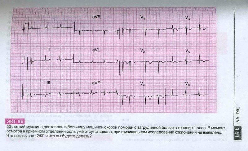 Часов с экг. Порок сердца на ЭКГ. Митральный порок сердца на ЭКГ. ЭКГ при митральном стенозе. Пороки на ЭКГ.