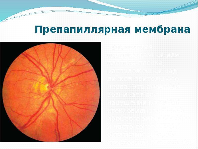 Аномалия развития зрительного нерва. Врожденные аномалии ДЗН. Врожденная патология зрительного нерва. Врожденная аномалия диска зрительного нерва. Презентация на тему врожденные аномалии зрительного нерва.