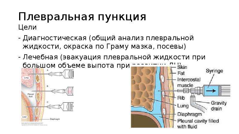 Пункция плевральной жидкости. Инструменты для плевральной пункции. Пункция плеврального выпота. Пункция плевральной полости заключение. Цели исследования плевральной жидкости.