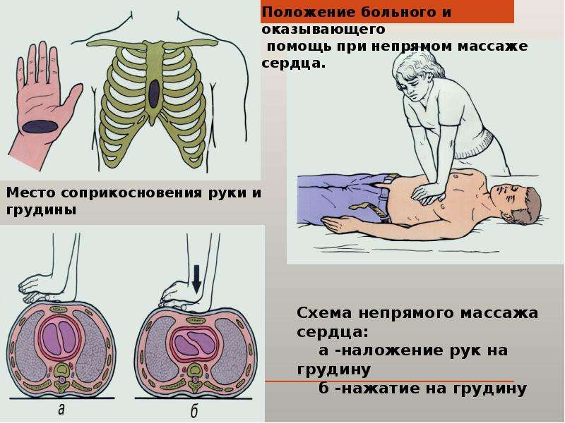 Презентация на тему непрямой массаж сердца