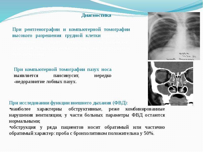 Синдром картагенера презентация