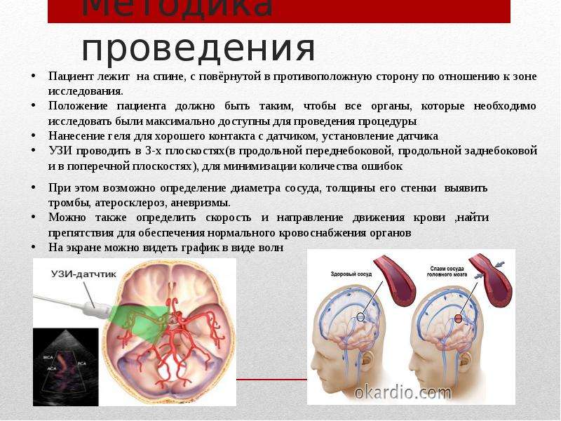 Атеросклероз брахиоцефальных артерий