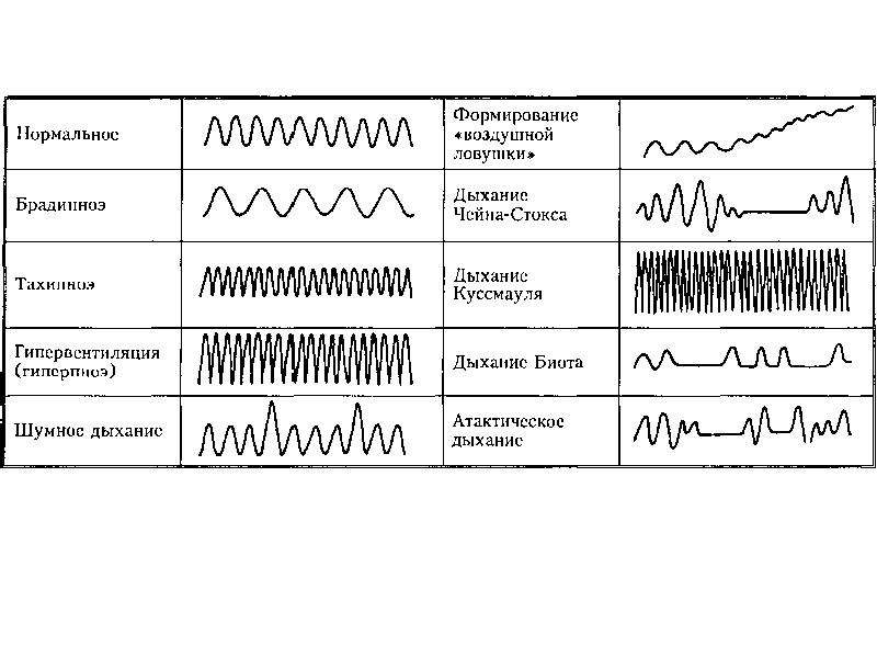 Назовите типы дыхания. Ритм дыхания патологические типы дыхания. Дыхание Биота Чейна Стокса Куссмауля. Патологические типы дыхания патофизиология. Патологические типы дыхания схема.