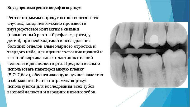 Рентгенография в стоматологии презентация