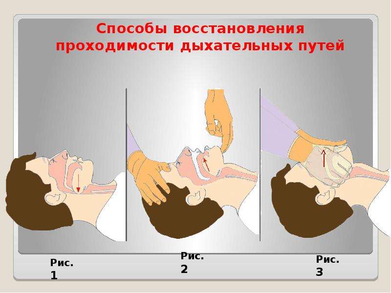 Как обеспечить восстановление проходимости дыхательных. Сердечно легочная реанимация проходимость дыхательных путей. Метод восстановления и поддержания проходимости дыхательных путей. Восстановление проходимости дыхательных путей тройной прием. Метод открытия дыхательных путей пострадавшему.