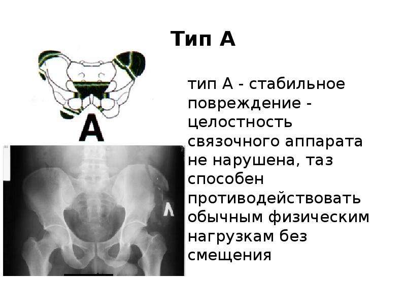 Повреждения таза презентация