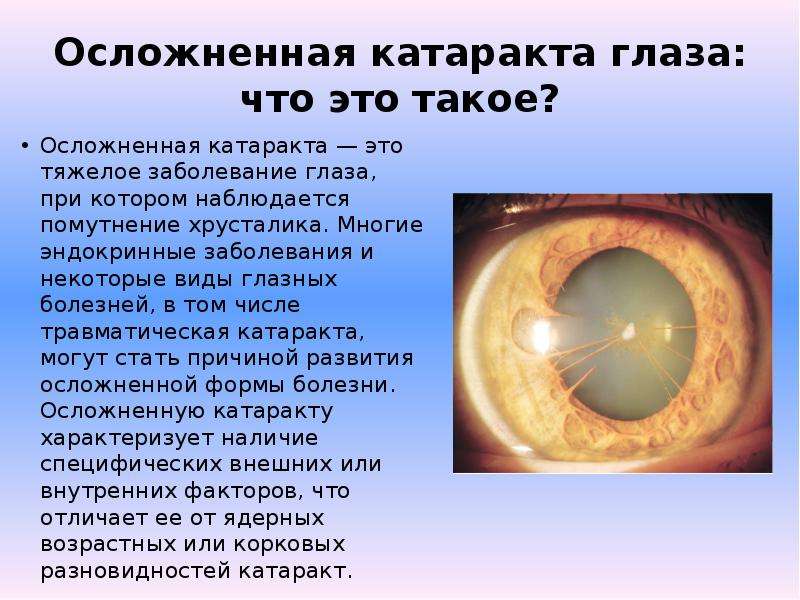 Что после катаракты нельзя делать. Миопизирующая катаракта. Осложненная катаракта. Осложненная катаракта глаз. Заболевания хрусталика глаза офтальмология.