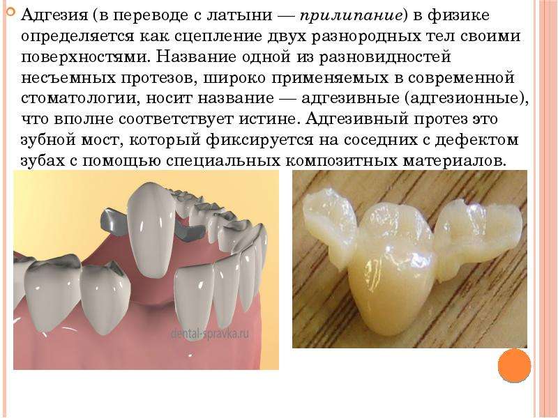 Адгезивный мостовидный протез что это такое фото