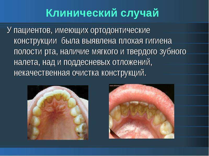 Клинический случай У пациентов, имеющих ортодонтические конструкции была выявлена плохая гигиена пол