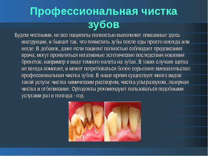 Профессиональная чистка зубов Будем честными, не все пациенты полностью выполняют описанные здесь ин