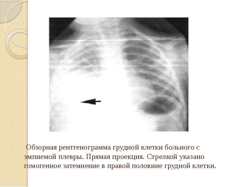 Пневмоторакс лучевая диагностика презентация