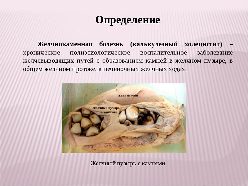 Жкб карта вызова. Холецистит полиэтиологическое. Желчнокаменная болезнь дипломная. Особенности сестринского ухода при желчнокаменной болезни.