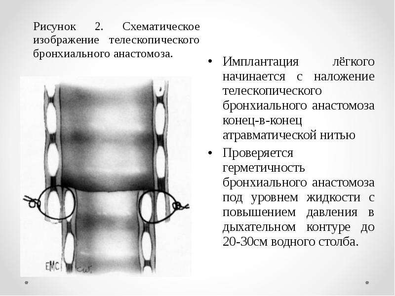 Трансплантация легких презентация