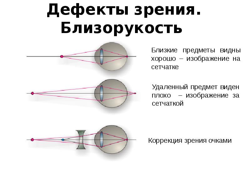 Презентация дефекты зрения очки