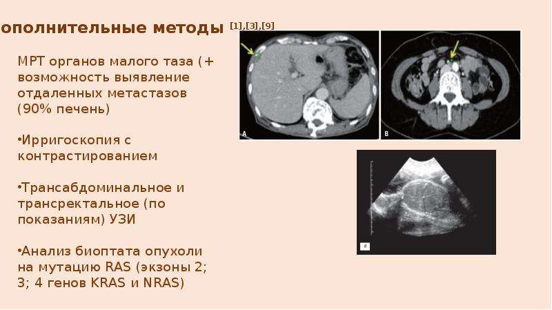 Вылечили рак 4 стадии с метастазами
