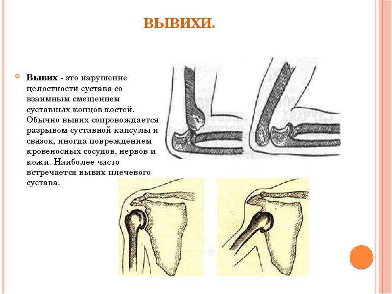 Перелом локтевого сустава карта вызова