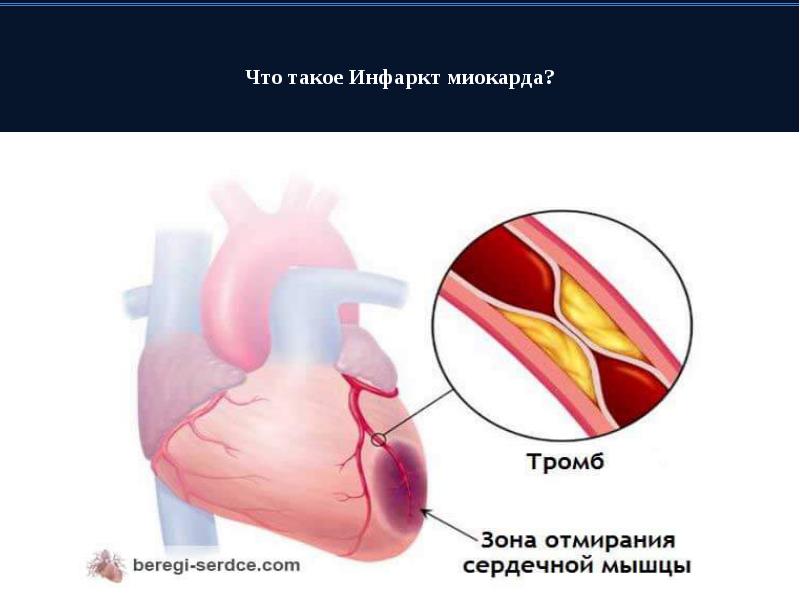 Инфаркт что это такое. Инфа.