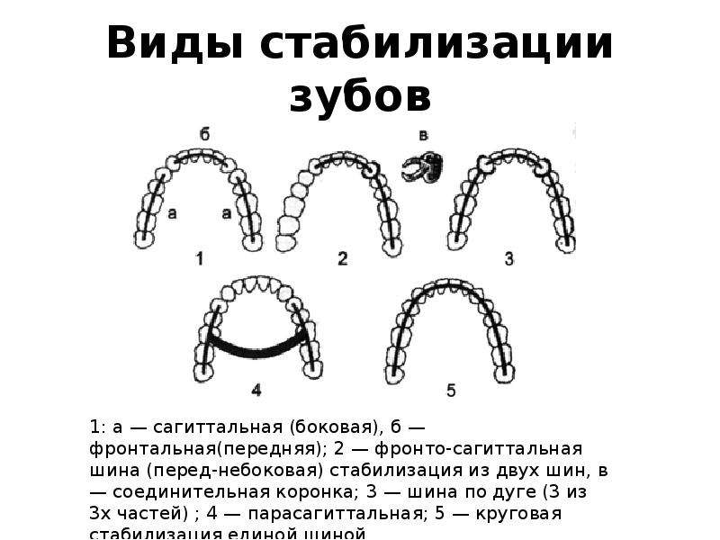 Схема сошлифовывания гипса на модели при изготовлении иммедиат протеза