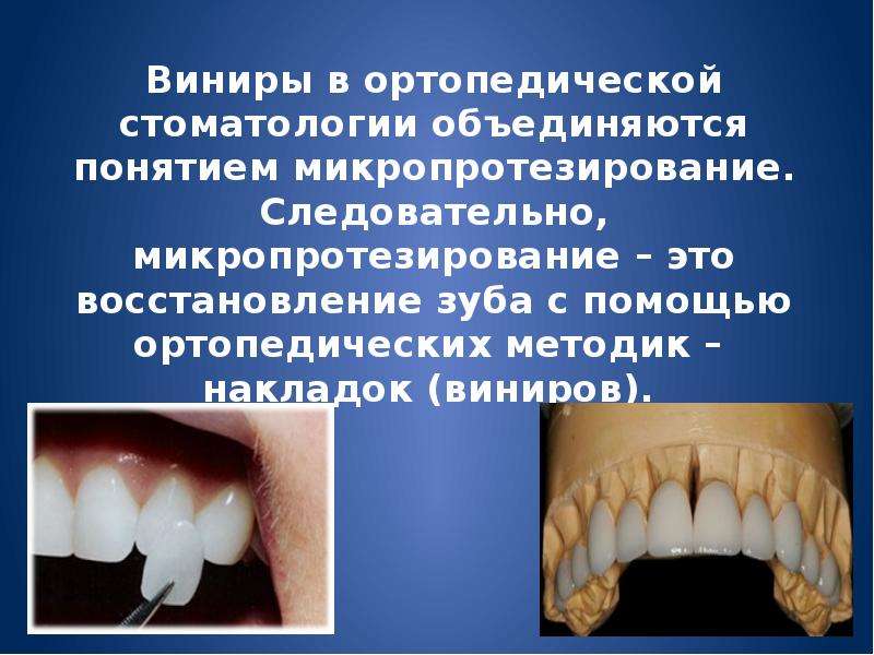 Виниры в ортопедической стоматологии объединяются понятием микропротезирование. Следовательно, микро