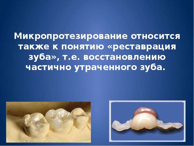 Микропротезирование относится также к понятию «реставрация зуба», т. е. восстановлению частично утра